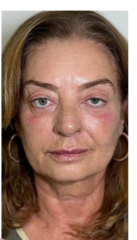 Resultado de toxina botulínica full face