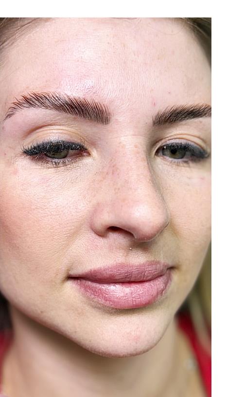 Resultado de preenchimento labial e rinomodelação