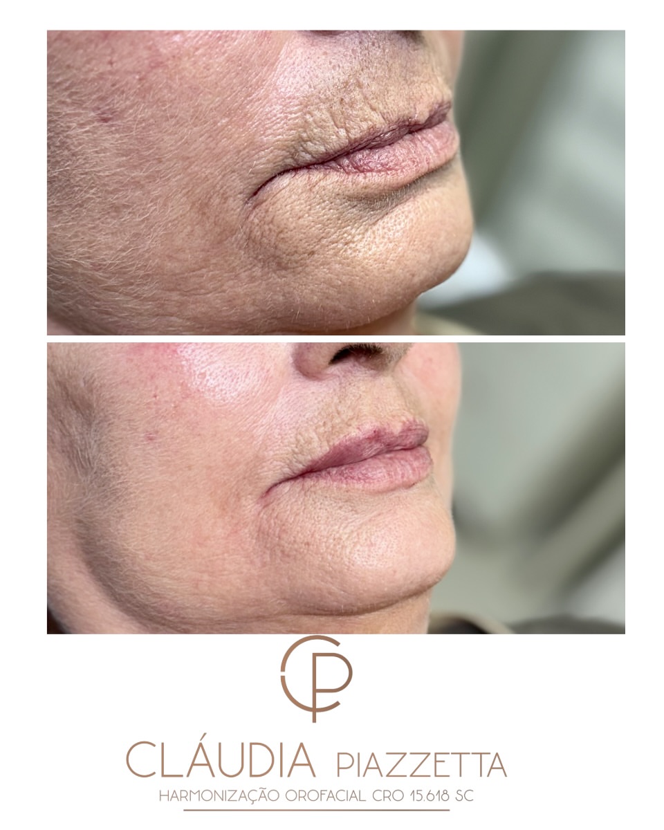Antes e depois — código de barras