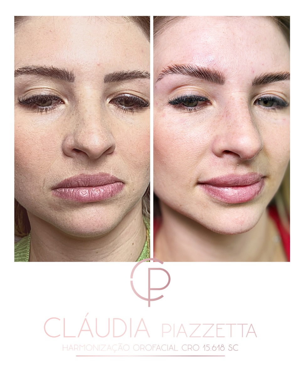Antes e depois — preenchimento labial e rinomodelação