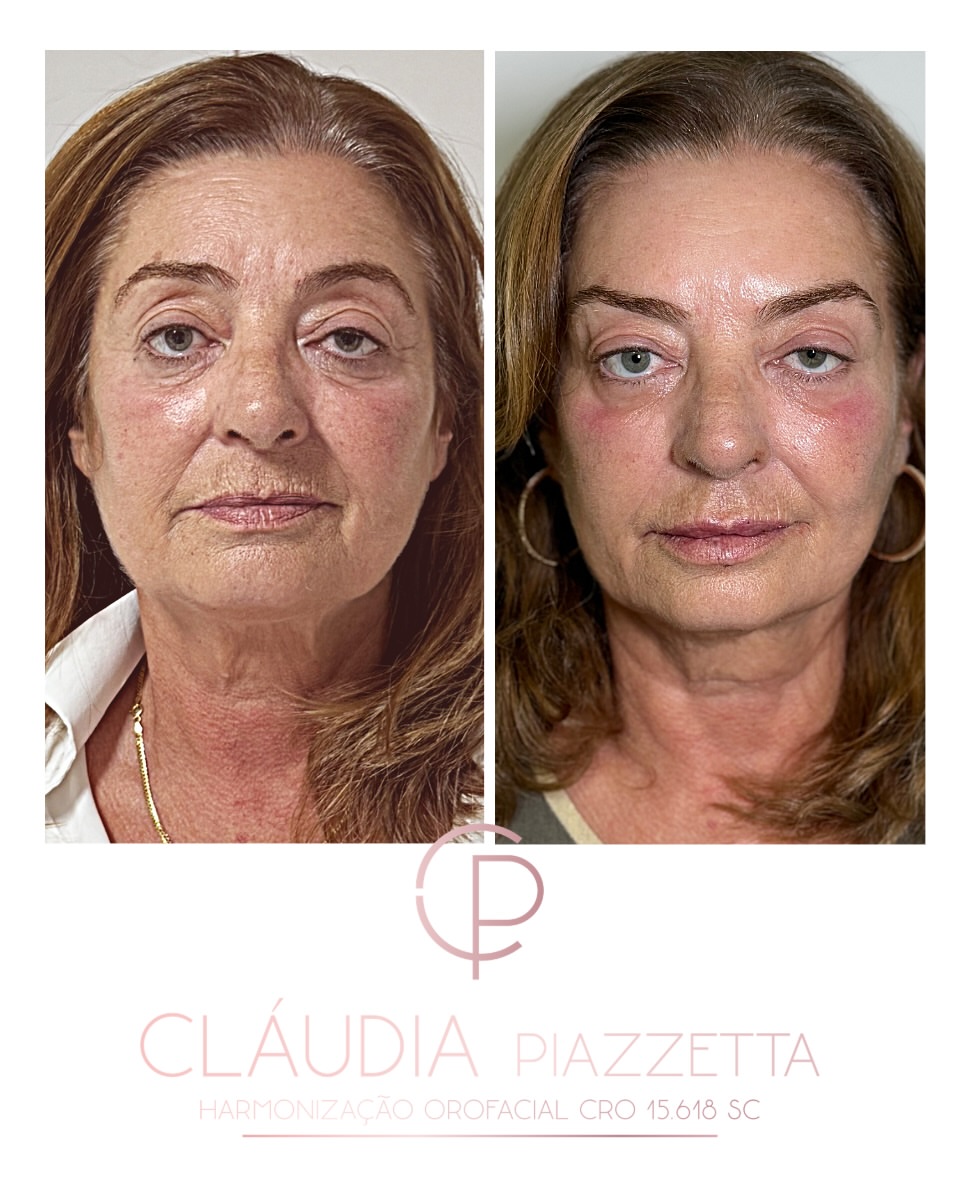 Antes e depois — toxina botulínica full face e Nefertiti Lift