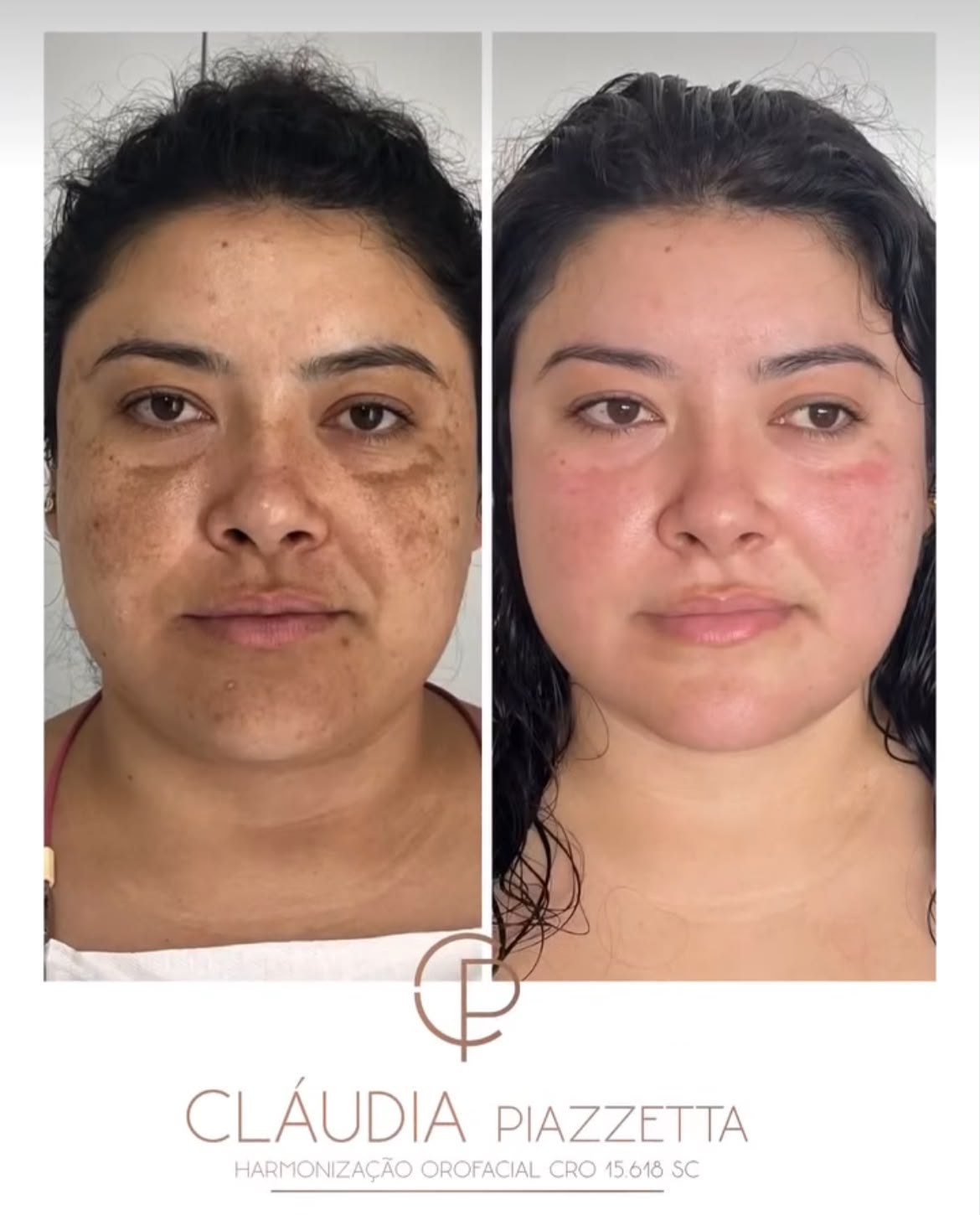 Antes e depois — microinfusão de medicamentos