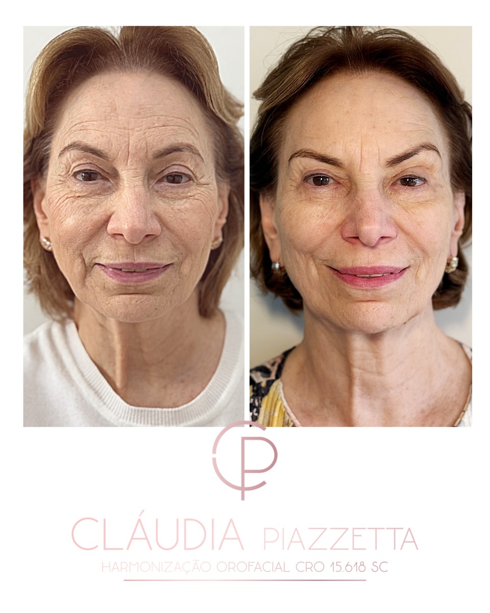 Antes e depois — rejuvenescimento facial
